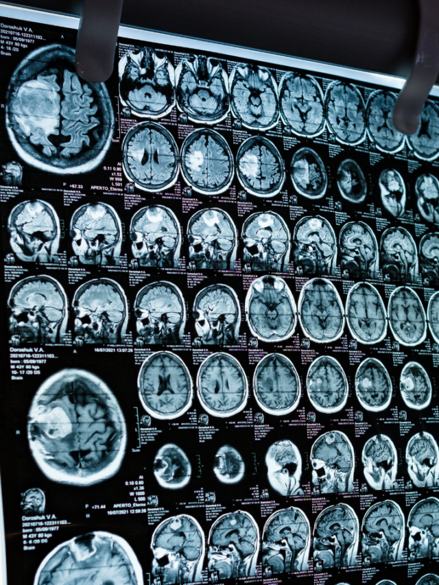South Dakota Traumatic Brain injury attorney